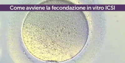 Come avviene la fecondazione in vitro ICSI