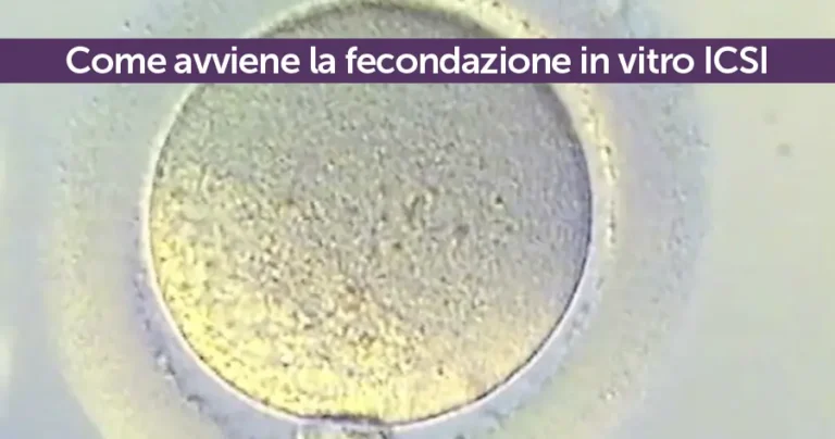 Come avviene la fecondazione in vitro ICSI