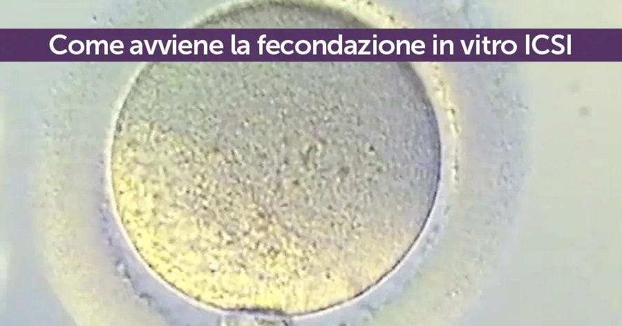 Come avviene la fecondazione in vitro ICSI